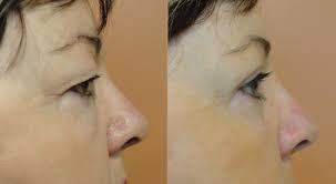 Improve the appearance of your nose with a rhinoplasty santa Barbara